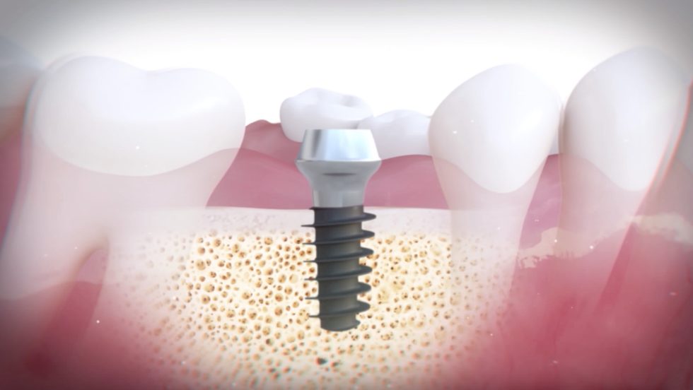 Magicore Implants Ibs Europe
